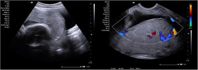 Absence of abnormal vascular changes on prenatal imaging aids in differentiating simple uterine scar dehiscence from placenta accreta spectrum: a case series